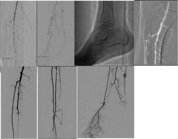 Figürler : Notlar : Transpedal arteryel yaklaşım