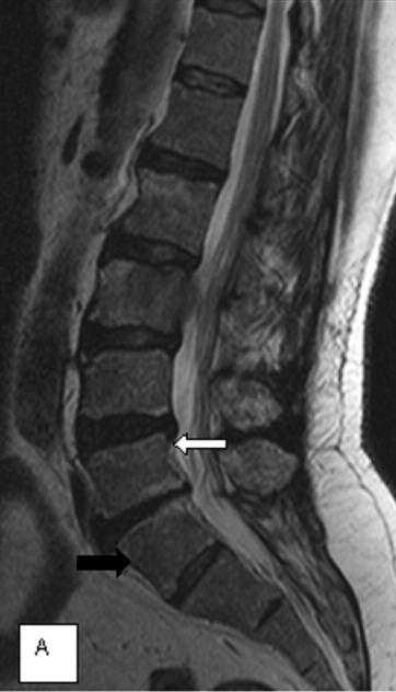 Radiology lomber vertebra özelliği göstermesidir.