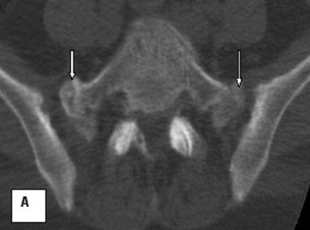 Oyar ve ark. RE SİM 6: Lumbosakral bileşke düzeyinden alınmış ardışık aksiyel bilgisayarlı tomografi kesitlerinde; bilateral sakralizasyon görünümü (oklar) izlenmektedir.