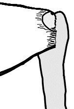 Genişliği 1-2 cm kadardır. Eğer tendonu çok germeden bir anatomik tamir mümkün değilse, tendon daha mediale tutturulur ve kemikteki yeri de buna göre hazırlanır.