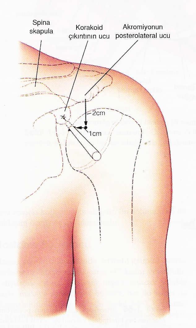 29 3.2. Yöntem ve Ameliyat Tekniği Hastalar genel anestezi altında ve şezlong pozisyonunda ameliyat edildi. Posterior, anterior ve lateral portallar kullanıldı.