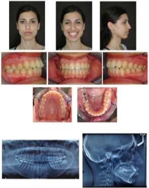 8 senelik takip sonrası hastanın ağıziçi ve ağızdışı fotoğrafları ile panoramik ve safalometrik röntgenleri İSKELETSEL DEĞERLENDİRME Vertikal Standart Başlangıç Headgea r Sonrası Bitim Kontrol Toplam