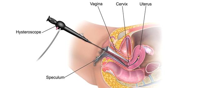 İntrauterin Adezyonların Önlenmesi ve Tedavisinde Adjuvan Tedavinin Etkisi: Randomize Kontrollü Çalışmaların Ağ Meta-analizi: Yang Y, Zu Dongmei J Minim Invasive Gynecol. 2017 Sep 8.