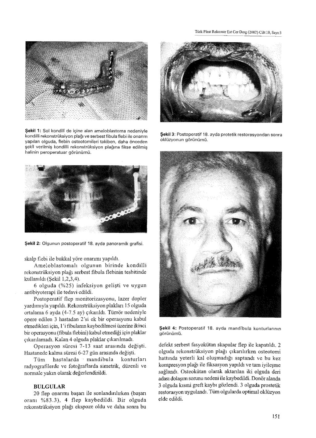Türk Plast Rekonstr Es t Cer D erg (2002) Cilt: 10, Sayı:3 Şekil 1: Sol kondili de içine alan ameloblastoıma nedeniyle kondilli rekonstrüksiyon plağı ve serbestfibula flebi ile onarım yapılan olguda,