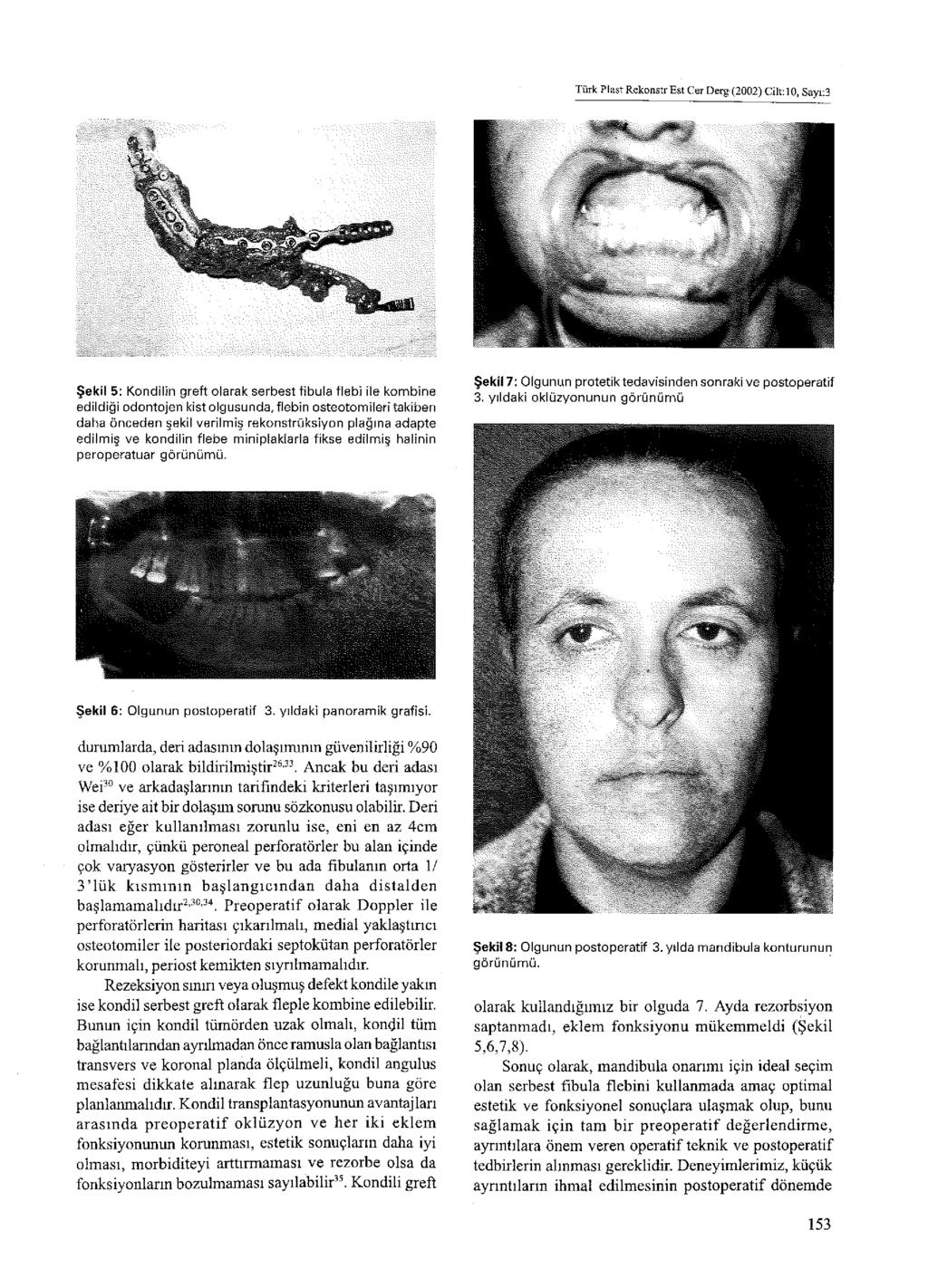 Türk Plast Rekonstr Est Cer Derg (2002) Cilt: 10, Sayı:3 Şekil 5: Kondilin greft olarak serbest fibula flebi ile kombine edildiği odontojen kist olgusunda, flebîn osteotomileri takiben daha önceden