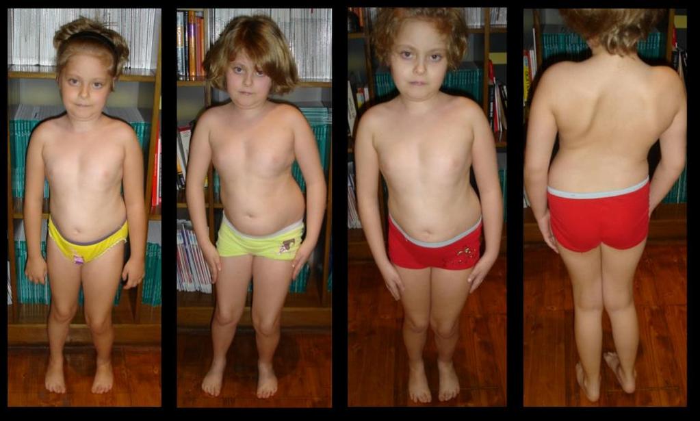 57 Resim 11: Sentronükleer myopati TTN mutasyonu. Farklı yaşlardaki fotoğraflarda hastalığın klinik gidişi görülmekte. 4,5 yaşında başlayan yürüme güçlüğü, 8 yaşında ortaya çıkan skolyoz.