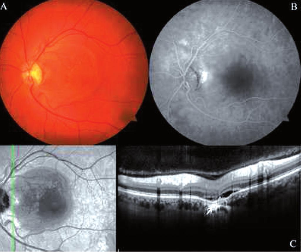 RESİM 3: Sol gözün renkli fundus fotoğrafında; A) optik disk piti ve seröz dekolman, B) FFA da lezyon alanında pencere defekti ve dekolman alanında zamanla artış gösteren hiperfloresan ve C) OKT