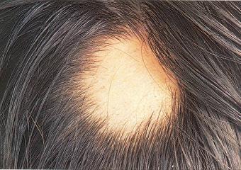 Alopesi