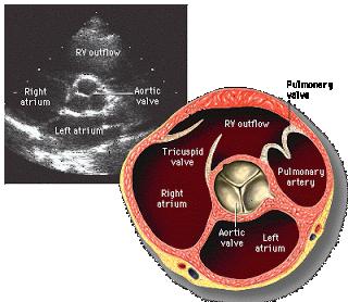 monokasplı kapakta, daha az sıklıkla biküspit kapakta görülür, üç kasplı aort kapağında görülmez (1). (A) (B) A- Diyastolde normal aort kapak. B- Sistolde BAK- Ok rafeyi gösteriyor (38, 39). Resim 2.