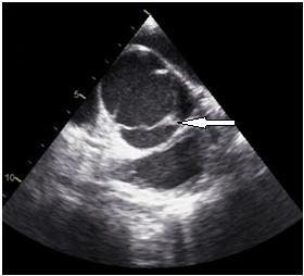 Bu bebeklerde pulmoner hipertansiyon nedeniyle, sağ ventrikül de genellikle geniştir. Sol ventrikül ve aort arasındaki gradient, darlığın şiddetini gösterir.