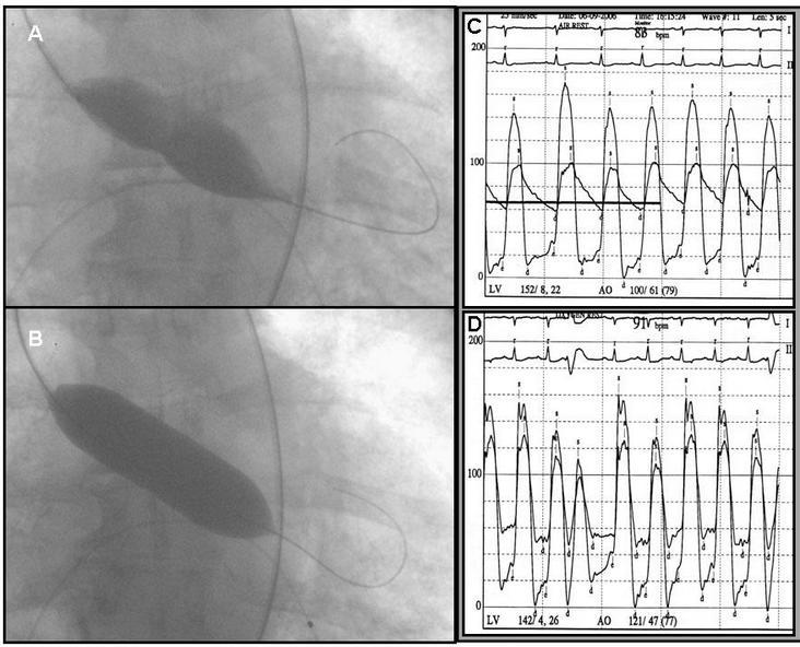 Resim 2.12. Aort balon valvüloplasti işlemi. Balondaki çentikleşme dikkati çekmektedir. Ayrıca sağ taraftaki grafide, sol ventrikül ve aort basıncı arasındaki gradent değişimi görülmektedir (51). 2.1.6.