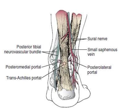 Artroskopik ayak bileği artrodezinin prensipleri açık tekniklerden çok farklı değildir.