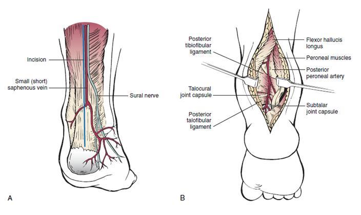 35 Şekil 23: Ayak bileğine posterior yaklaşım [17]. Kalkaneal tüberkülün 10-15 cm proksimalinden ve orta hattan uzunlamasına cilt insizyonu yapılır.