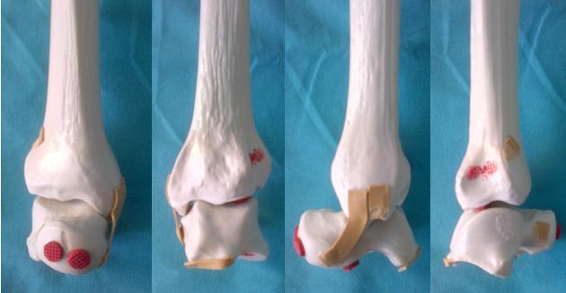 40 III- GEREÇLER VE YÖNTEM A- Deneyin Oluşturulmasında Kullanılan Gereçler Ayak bileği artrodezi modelinde vidalarla uygulanan tespitin stabilitesini test etmek amacıyla kullandığımız gereçleri beş