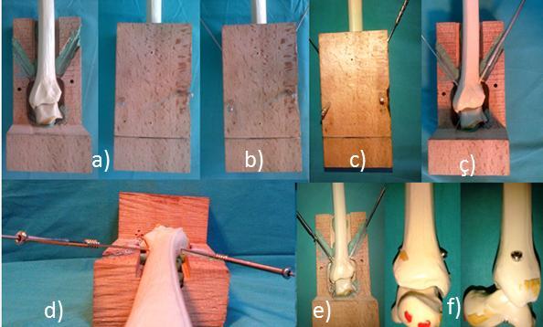 45 1. Ayak Bileği Artrodezinin Sentetik Kemik Modellerine Uygulanması Artrodez modelleri oluşturulurken standart olması açısından tüm modellerin pozisyonlanması ve vidaların yollanması aşamasında