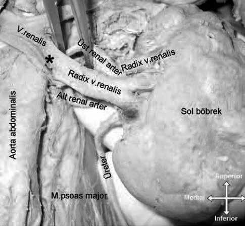 Renal damarların varyasyonu 121 damarlardaki varyasyonların ortaya konması, klinik değerlendirmeler açısından önemlidir. Böylece belki yeni bir sendrom ortaya konabilir.