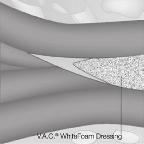 TÜNELLEME VE SINÜS KANALI TEKNIKLERI V.A.C. WhiteFoam Pansumanın tünellerde kullanılması önerilir. V.A.C. WhiteFoam Pansumanı her zaman bir ucu geniş, diğer ucu dar olacak şekilde kesin.