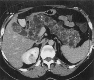 Halefoğlu ve ark. Resim 4. Kontrastlı BT görüntü, pankreas içerisinde parankimi tamamen kaplayan multipl sayıda hipodens kistik lezyonlar ve birkaç adet punktat kalsifikasyon izleniyor.