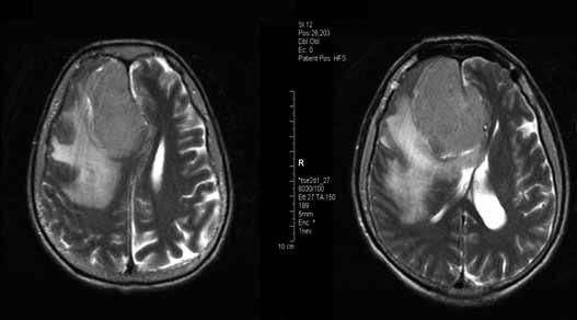 Şekil 1: Aksiyal T2 ağırlıklı MR görüntüsü: falks meningiomu ve çevresinde hiperintens görünen peritümöral ödem.