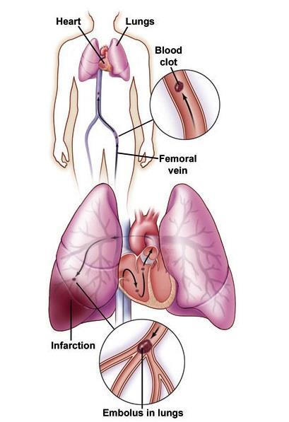 Pulmoner Emboli Venöz bir pıhtının pulmoner arter yatağını tıkaması