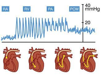Pulmoner Hipertansiyon PH istirahat halinde sağ kalp