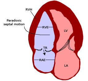 EKO PAB artışı RV fonksiyonları RA/RV hipertrofi Septum deviasyonu RV/LV