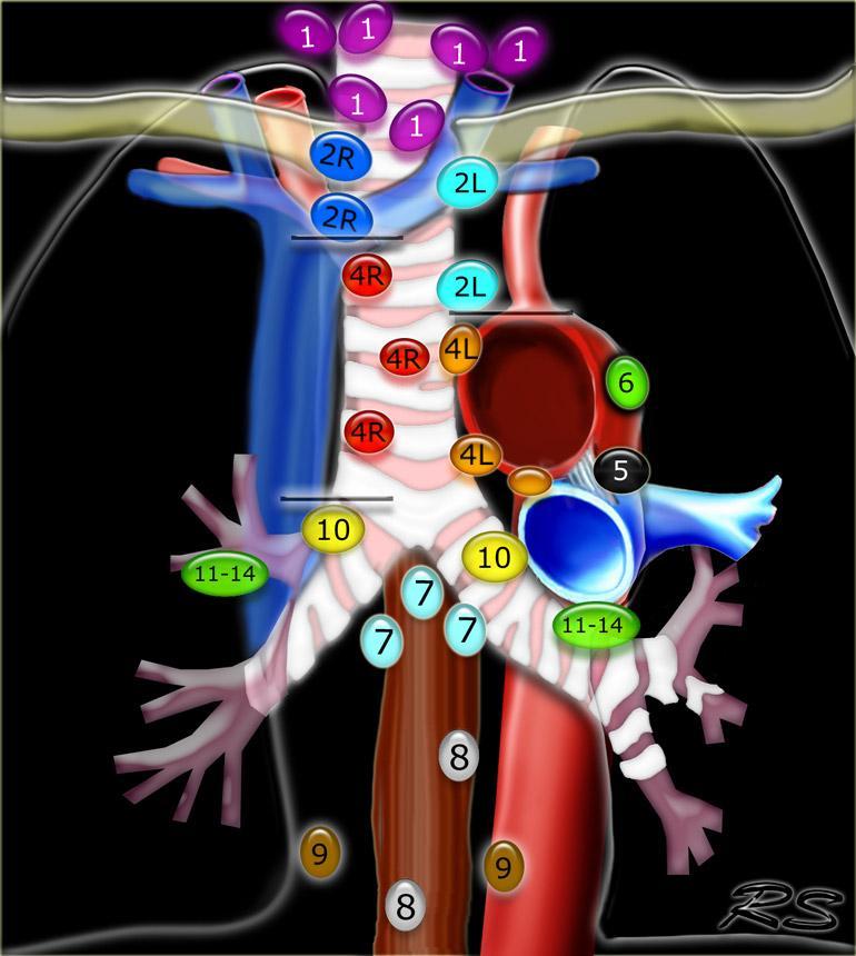 ġekil 2: Lenf nodu haritası (Regional lymph node classification for lung