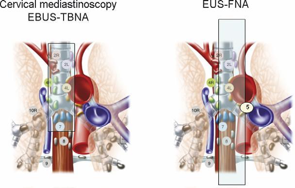 ġekil 6: EBUS İA ve EUS İA ile ulaşılabilen lenf nodlarının şematize görüntüsü(4,29) c) Transtorasik iğne aspirasyon biyopsisi (TTĠĠAB) TTİİAB si akciğer hastalıkları tanısında sık kullanılan bir