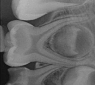 Radyolojik muayenesinde; - Lamina dura ve periodontal aralığın normal olduğu, - Kök çevresinde herhangi bir lezyonun bulunmadığı, - İnternal ya da eksternal rezorpsiyonu bulunmayan ve -