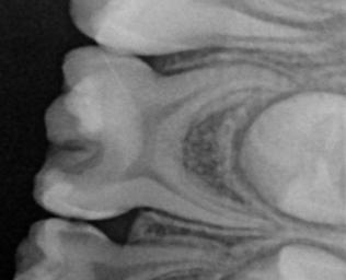 A B Resim 1: A) Çürüğün temizlenmesi sırasında mesialdeki pulpa boynuzunun perfore olacağı düşünüldüğünden çalışmamıza dahil edilmeyen bir diş örneği B) Çalışmamıza dahil edilen bir diş