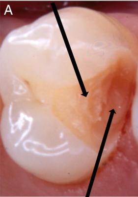 Resim 26: A) Açık sarı ve sarı dentin rengi. B) Açık kahverengi dentin rengi C) Koyu kahverengi/siyah dentin rengi Kıvam ise sondun dentine saplanma miktarı ve kolaylığına göre değerlendirilmiştir.