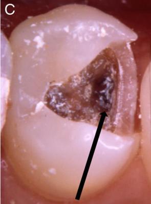 ikrobiyolojik eğerlendirme Mikrobiyolojik incelemeler için, tüm gruplardaki dişlerden dentin örnekleri alınmıştır.