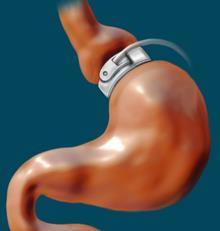 Cerrahi Tedavi Yöntemleri: o Implantable Gastrik Stimulasyon