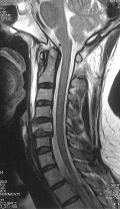 C5 vertebra kırığı Ön eleman hasarı (2) Sagittal ötelenme