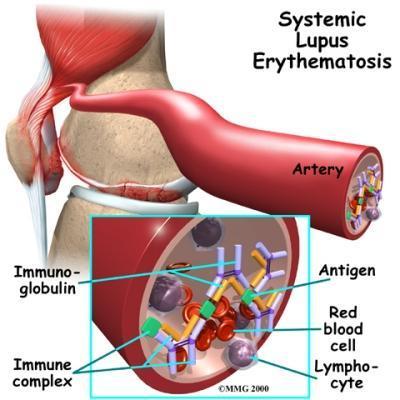 Tanım: Sistemik Lupus Eritematozus (SLE), iyi tanımlanmış epizodik, birçok sistemi