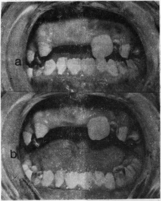 TAURODONTİZM VE 18p SENDROMU bu dişlerde ileri derecede kuron harabiyeti ile karakterize yaygın çürükler mevcuttu. Ağız hijyenininde kötü olduğu (Şekil-2) tespit edildi.