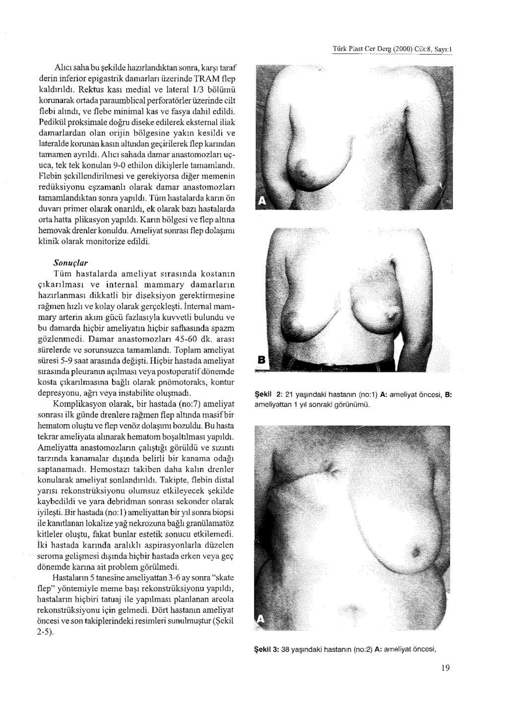 Türk Plast Cer Derg (2000) Cilt:8, Sayı: 1 Alıcı saha bu şekilde hazırlandıktan sonra, karşı taraf derin inferior epigastrik damarları üzerinde TRAM flep kaldırıldı.
