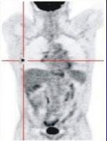 FDG PET/CT FDG PET/CT Mesane Tm Evrelemesinde