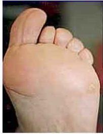 ÇOK DÜŞÜK RİSK (ADA Risk Kategori 0) HK veya periferik arter hst yoktur Hastanın ayak