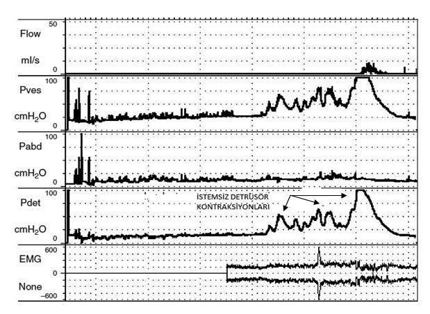 BÖLÜM 13 Detrüsör Aşırı Aktivitesi 103 Şekil 4. Fazik Detrusor aşırı aktivitesi. Dolum sistometri sırasında kaçırma saptanmamış.