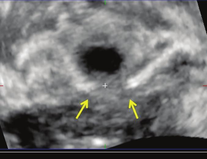 Translabiyal ultrason insizyon yerini göstermiş ve sling meşinden arta kalanları saptanmıştır. (Resim 4) Resim 4. Olgu 1.