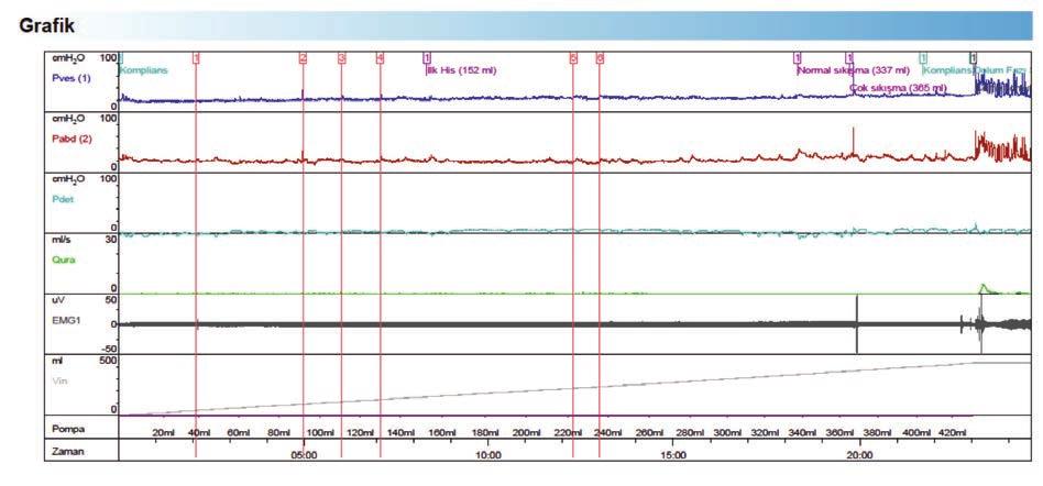 BÖLÜM 20 Pediatrik Hasta Grubu Ürodinami Örnekleri 173 OLGU-2 13 yaşında meningomiyelosel nedeniyle opere olmuş olan ve nöropatik mesane sebebiyle