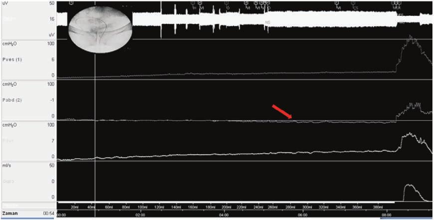 74 BÖLÜM 9 Artefaktların Yorumlanması Şekil 3. Test sırasında dinlenme değerinin altına düşen abdominal basınç trasesi. lidir.