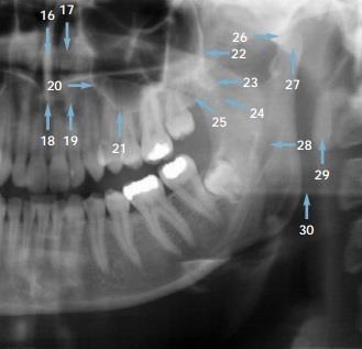 16. Nasal septum 17. İnferior konka 18. Anterior nasal spine 19. Nasal kartilajın gölgesi 20. Maksiller sinüsün medial duvarı 21. Maksiller sinüsün tabanı 22.