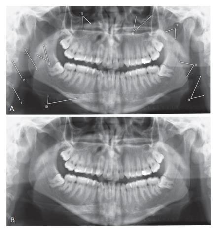 1, 2. Servikal vertebra. 3. Kulak kepçesi 4. Yumuşak damak ve uvula 5. Sert damak (Alttaki çizgi; tüp tarafındaki sert damak ve nasal kavitenin lateral duvarının birleşimi.