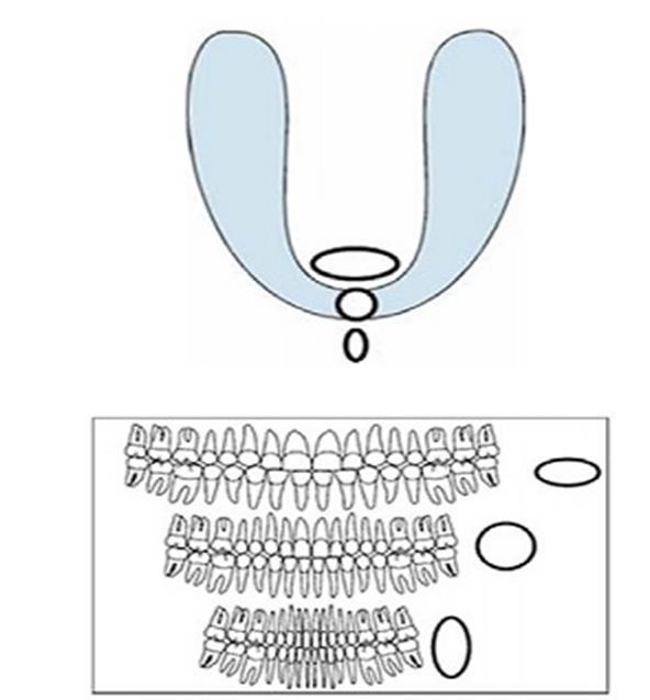 Isırma çubuğunun/imaj tabakasının lingualinde kalan yapılar genişler.