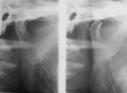 a b Resim 59: Olgu 2 nin a) Apereyli röntgeni b) Apereysiz bitiş röntgeni Olgu 3: Hasta