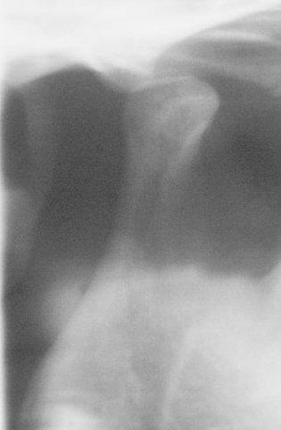 Resim 62: Olgu 3 ün lateral eklem röntgeni (ağız açık) Hastanın