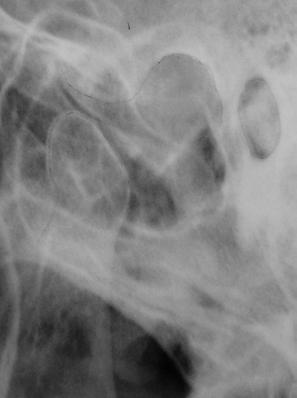 Hastanın başlangıç röntgenlerinde sol kondilin retro pozisyonda olduğu, dolayısıyla