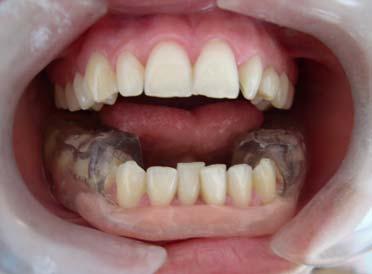 Posterior bölge splintleri: Arka dişlerini sıkıp gıcırdatan ve alt çenenin bir oranda geriye konumlanmasına neden